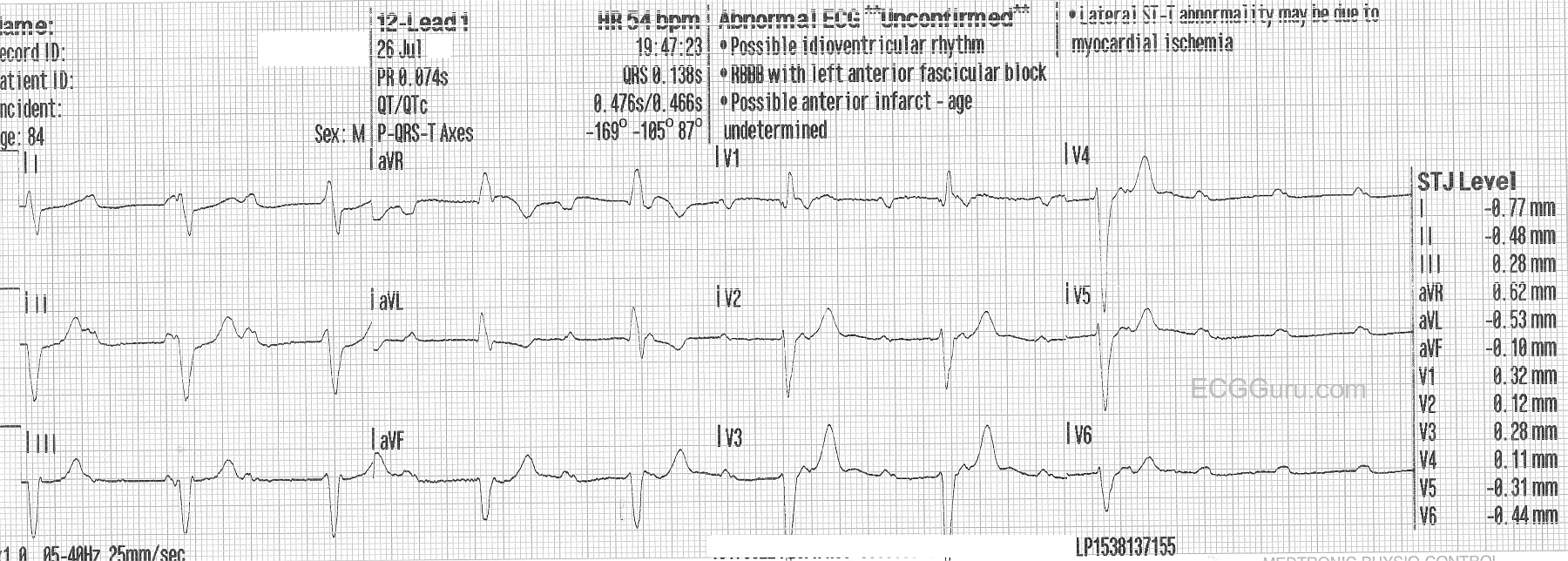 Complete Heart Block ECG Guru Instructor Resources